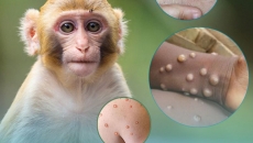 Một số khuyến cáo cần làm khi mắc bệnh đậu mùa khỉ hoặc tiếp xúc gần người bệnh?