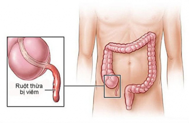 Vai trò siêu âm trong chẩn đoán, định hướng điều trị viêm ruột thừa