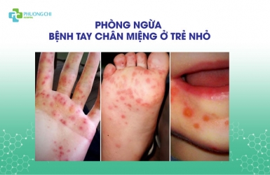 Phòng ngừa bệnh tay chân miệng ở trẻ nhỏ|Bệnh viện Đa khoa Phương Chi