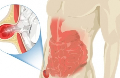 Thoát vị bẹn: Triệu chứng và cách điều trị